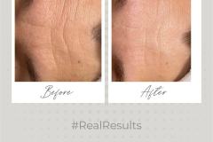 02-dermlux-result
